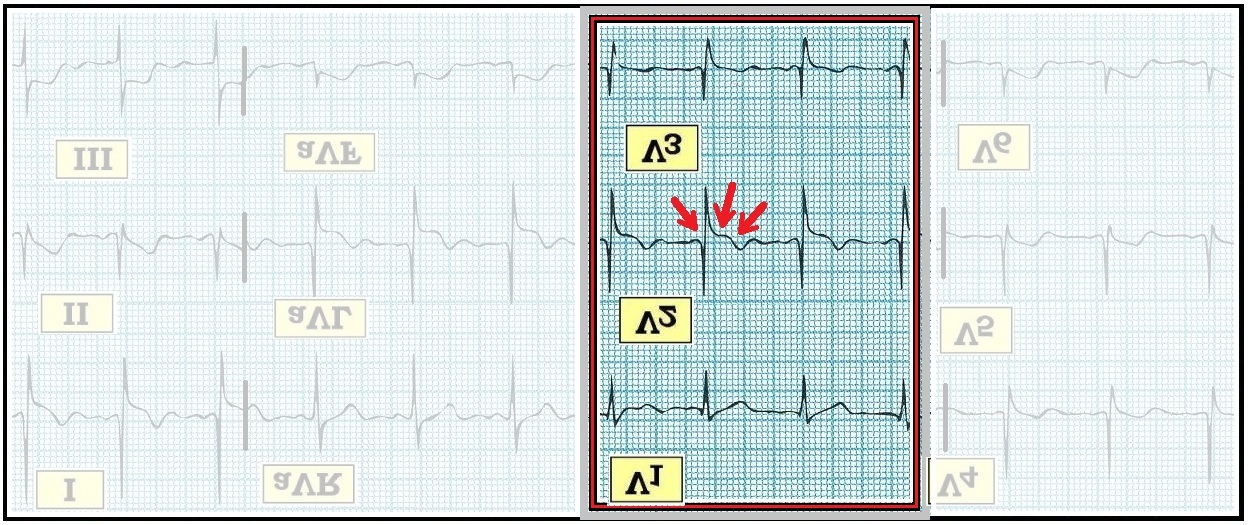ECG Interpretation ECG Blog 56 — A MirrorImage View