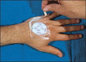 topical anesthesia laceration let repair before pediatric anything procedures club wait actually stuff much does figure principles