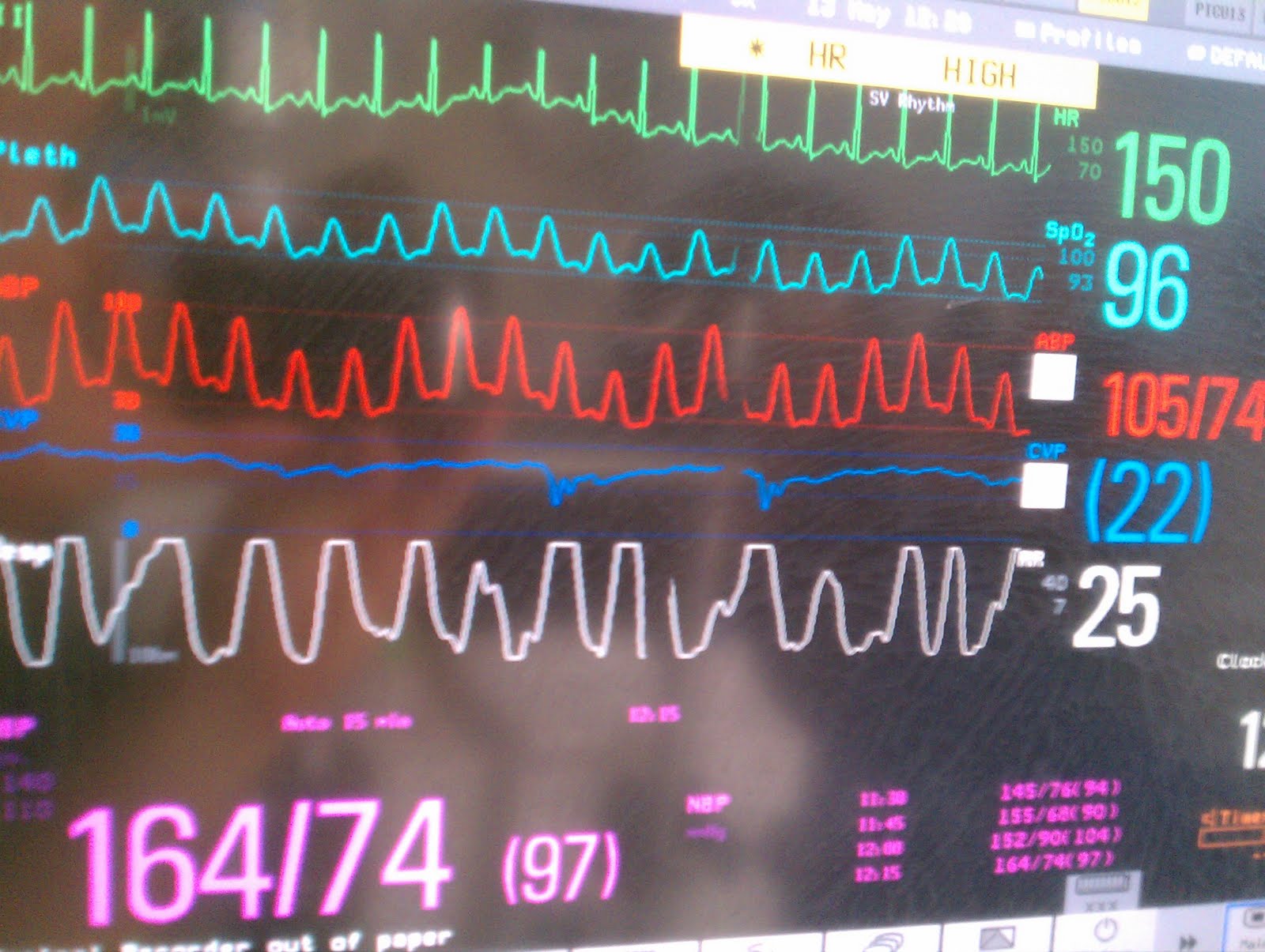 Pedi cardiology: ICU: Pulsus Paradoxus