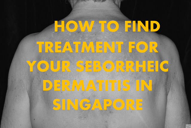 seborrheic dermatitis treatment singapore