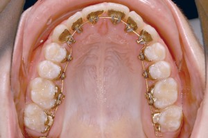 ¿Qué Es La Ortodoncia?