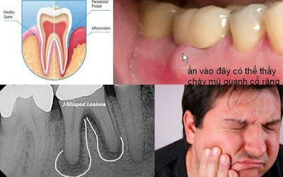 Các triệu chứng viêm chân răng người bệnh cần biết-2