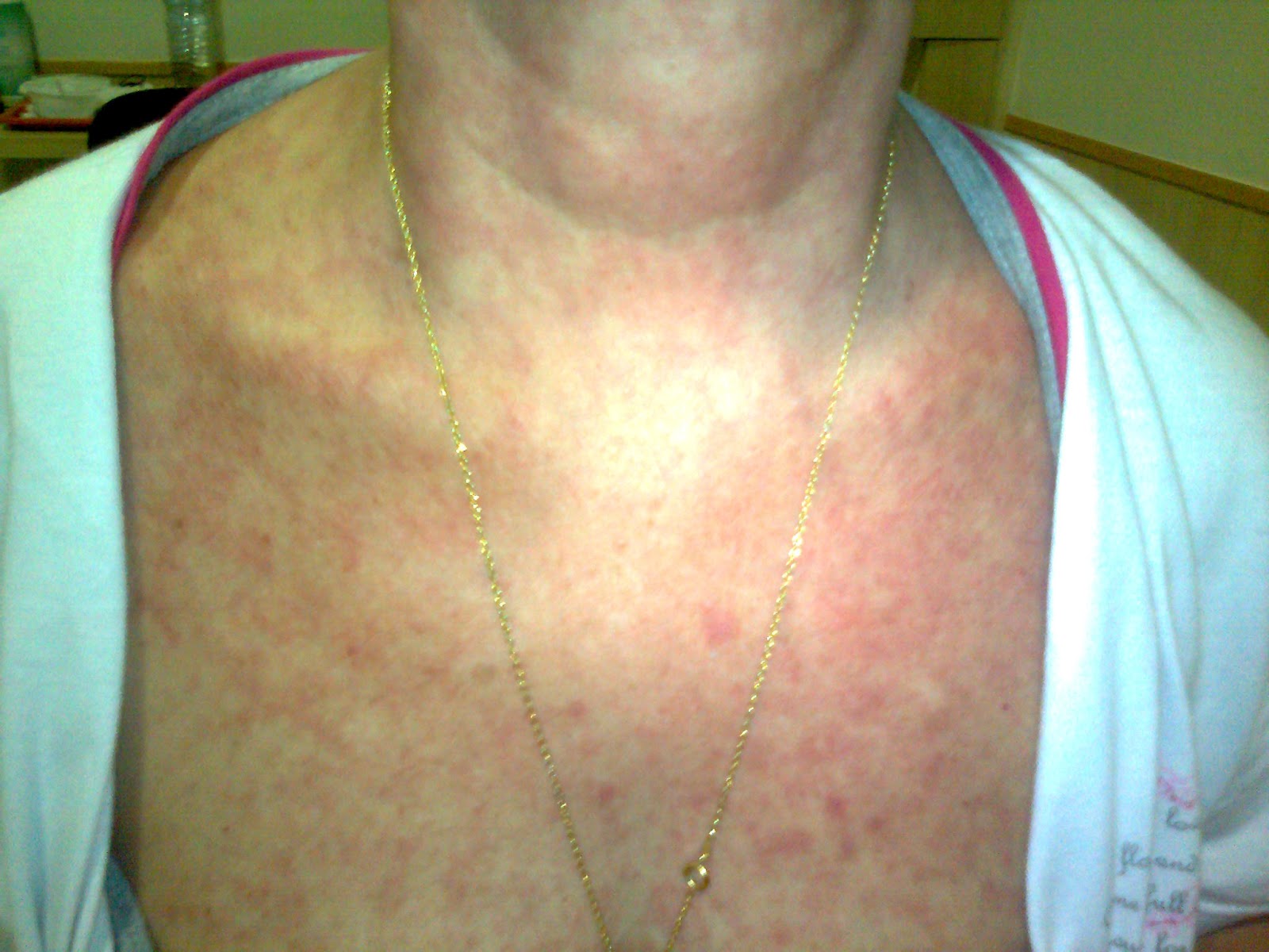 Removendo Montanhas - minha luta contra LLA (Leucemia Linfóide Aguda