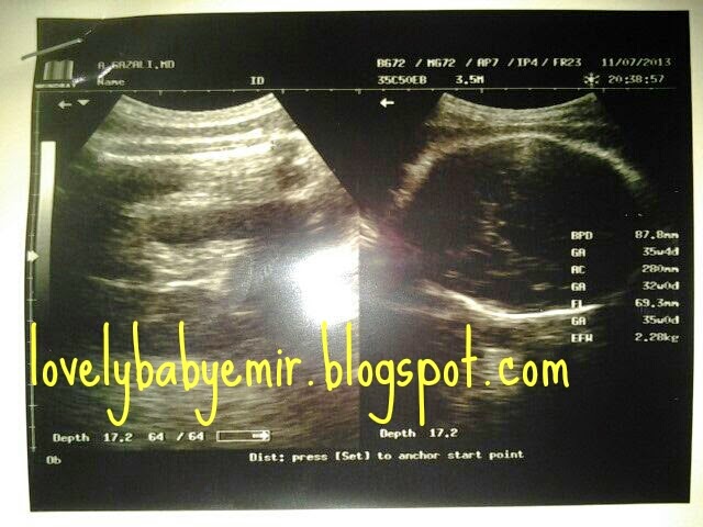 baby emir journey: Hasil USG dan Cara Membacanya