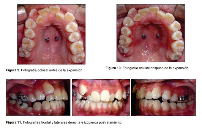 PDF: Expansión ortopédica del maxilar con miniimplantes ortodóncicos: Reporte de un caso