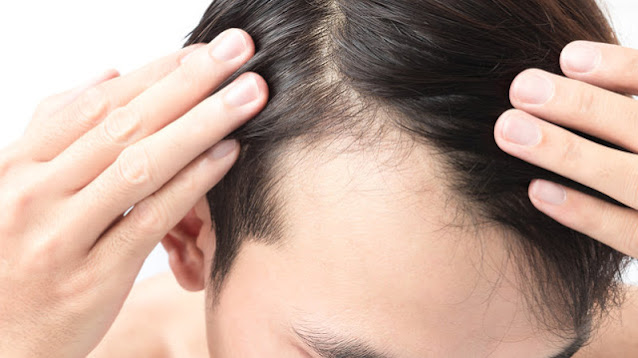 how to prevent receding hairline