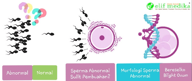 Morfologi Sperma Abnormal beresiko perkembangan embrio menjadi tidak sempurna (janin tidak berkembang) atau Blight Ovum Morfologi Sperma Abnormal beresiko perkembangan embrio menjadi tidak sempurna (janin tidak berkembang) atau Blight Ovum