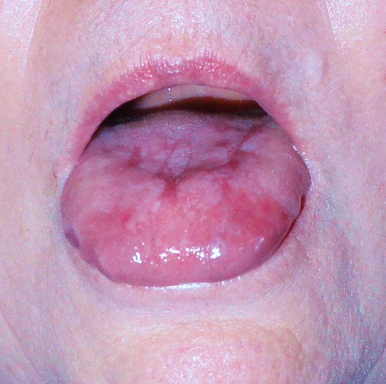 oral lichen planus