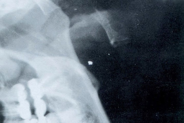 implantes alienígenas, ufologia, abdução, et, ets