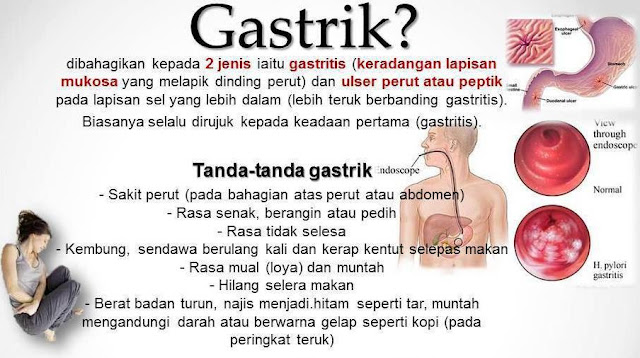 Gastrik ubat 1 Cara