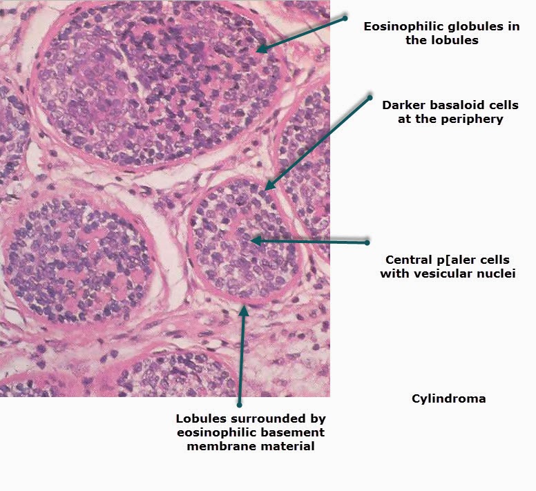 Malignant sweat gland tumours: an update - Cardoso - 2015 ...