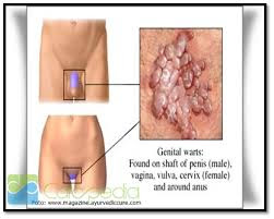 Obat Tradisional Penyakit Herpes Genital di Apotik