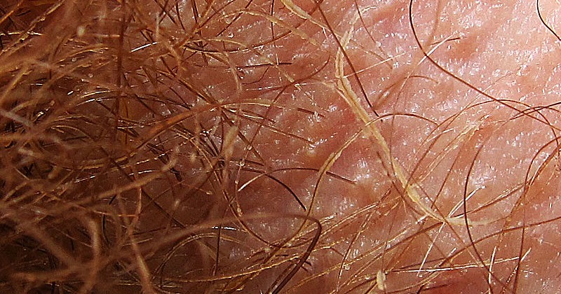 Causes Of White Brown Or Grey Coloured Armpit And Pubic Hair