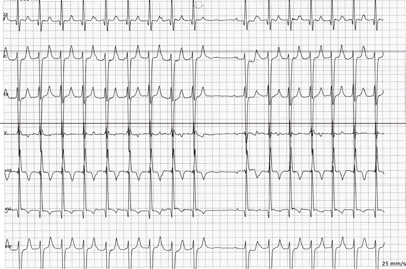 ECG Rhythms Atrial Tachycardia is Easier to Catch in Telemetry Floors