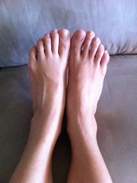Swollen And Inflammed Feet 59