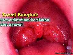 Punca Dan Penyebab Sakit Tonsil