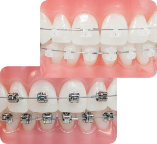 Kiến thức niềng răng kim loại cho khách hàng D%25C4%2591s
