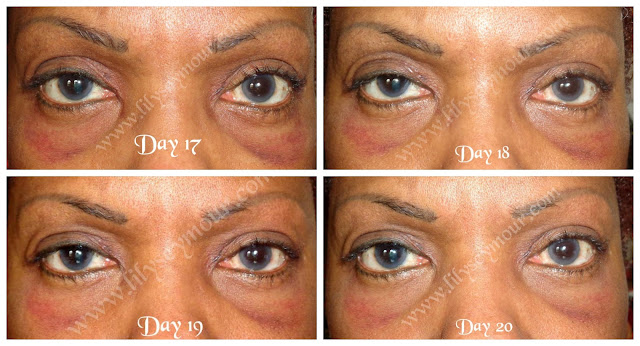 african american surgery eyelid blepharoplasty ethnic upper lift lifestyle hooded healed op almost lilyseymour eyelids cost cosmetic