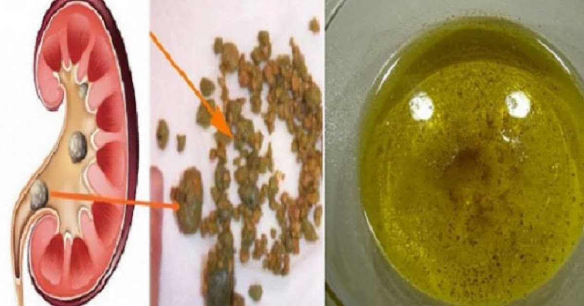 According To Expert How To Pass Kidney Stones Quickly With This Simple Drink!