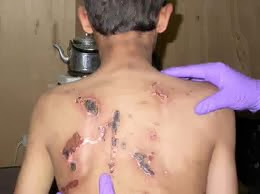 Prisoner with welts and bruises at Guantanamo Bay