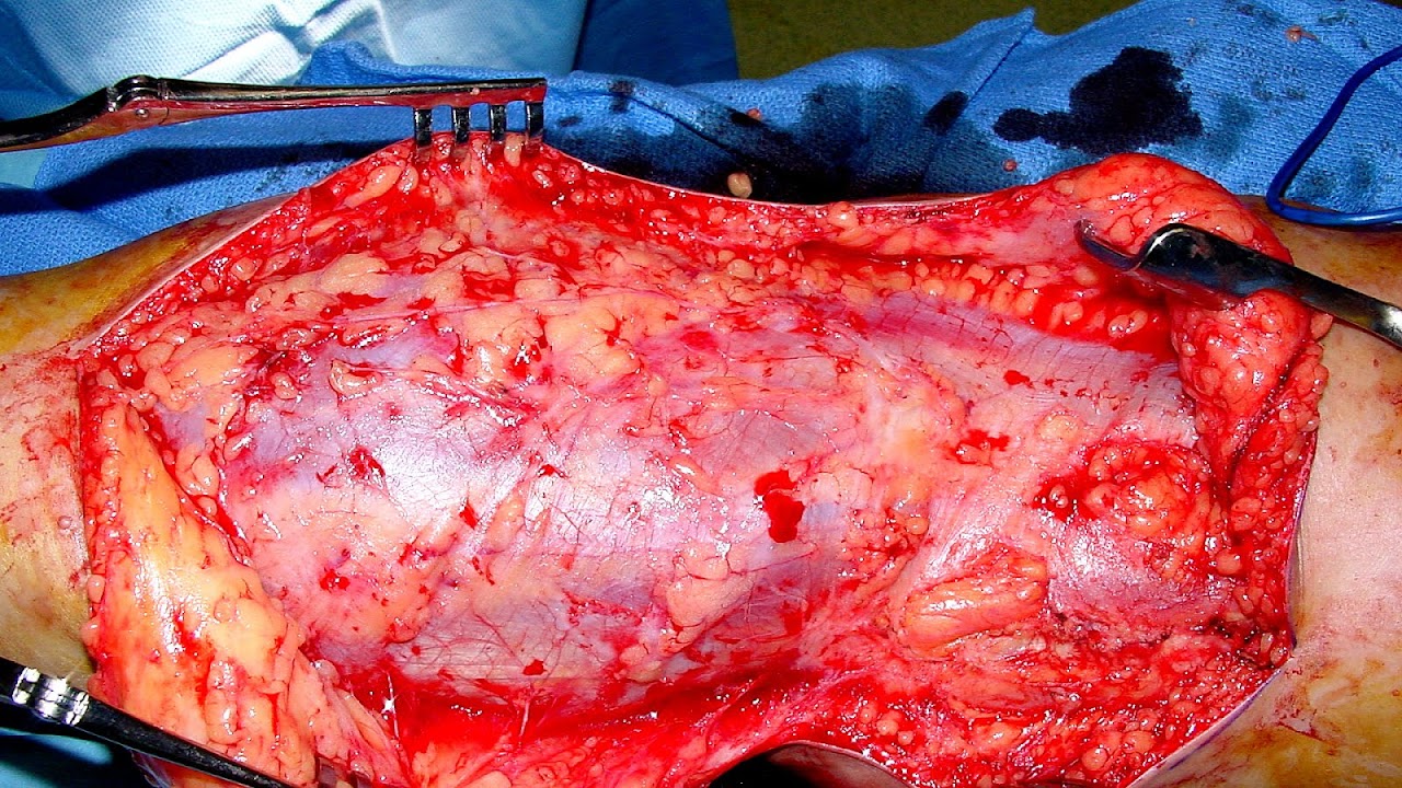 Bone Cancer Knee Knee Choices