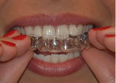 Niềng răng không mắc cài 3D Clear