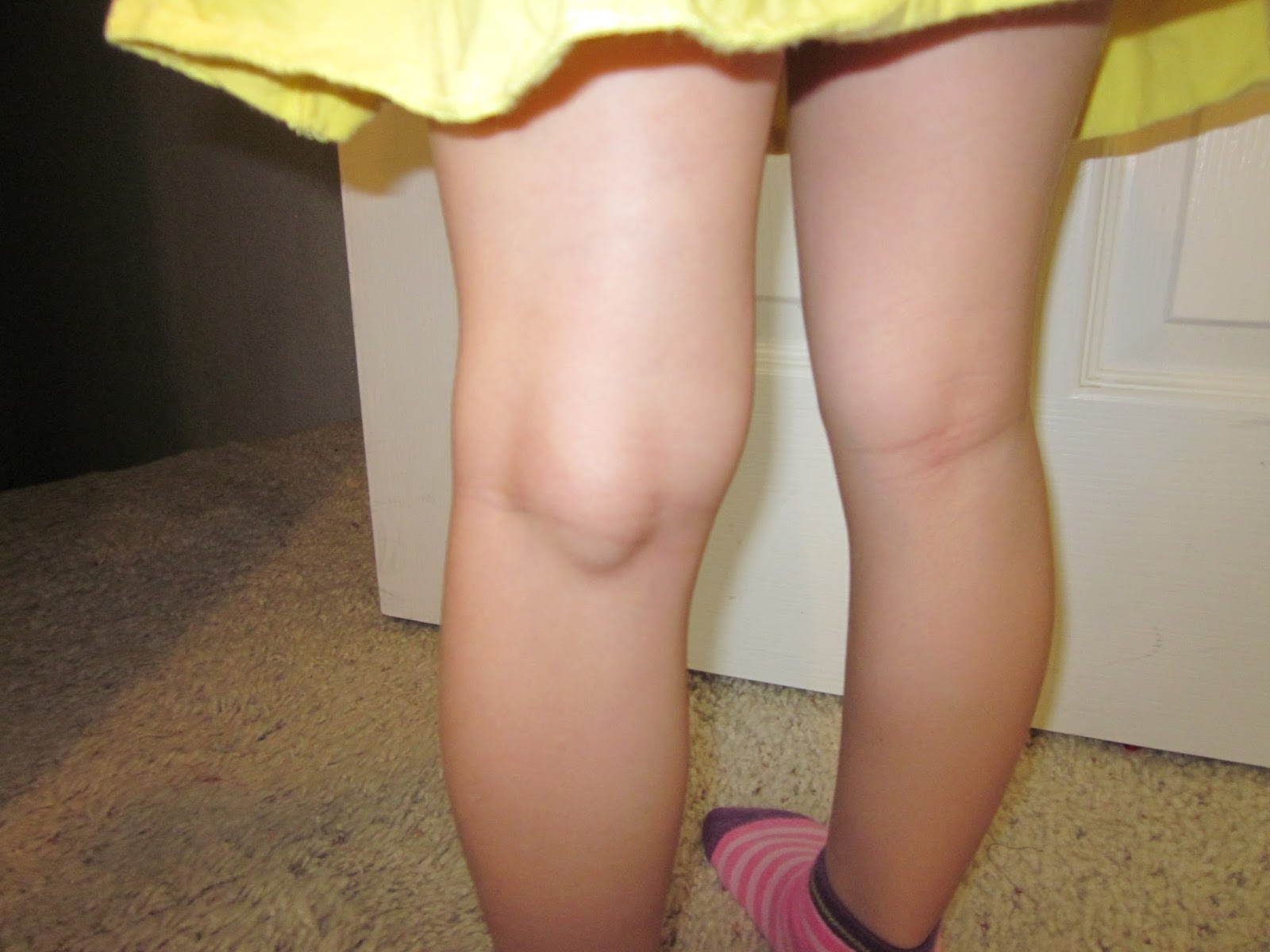 Steph's Stories Baker's cyst