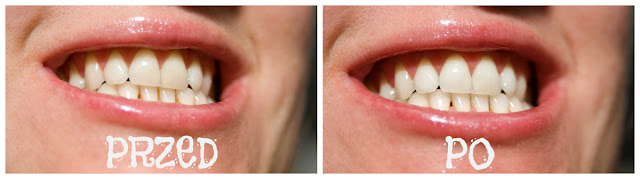 efekty wybielania zębów metod węgla aktywnego