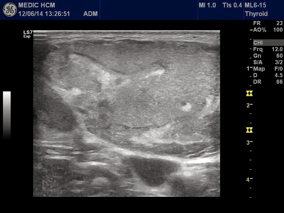 VIETNAMESE MEDIC ULTRASOUND CASE 263 BUFFALO'S NECK, Dr PHAN THANH