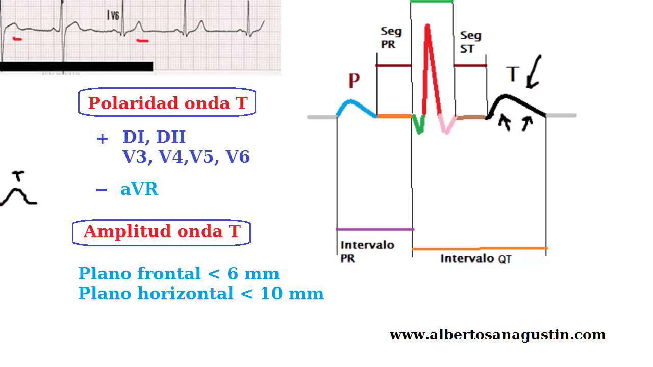 Electrocardiograma y onda T, polaridad y amplitud