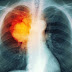 Scientists in Amsterdam Just Destroyed Breast Cancer Tumors in 11 Days Without Chemo