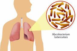 Non Pharmacology Tuberculosis Disease