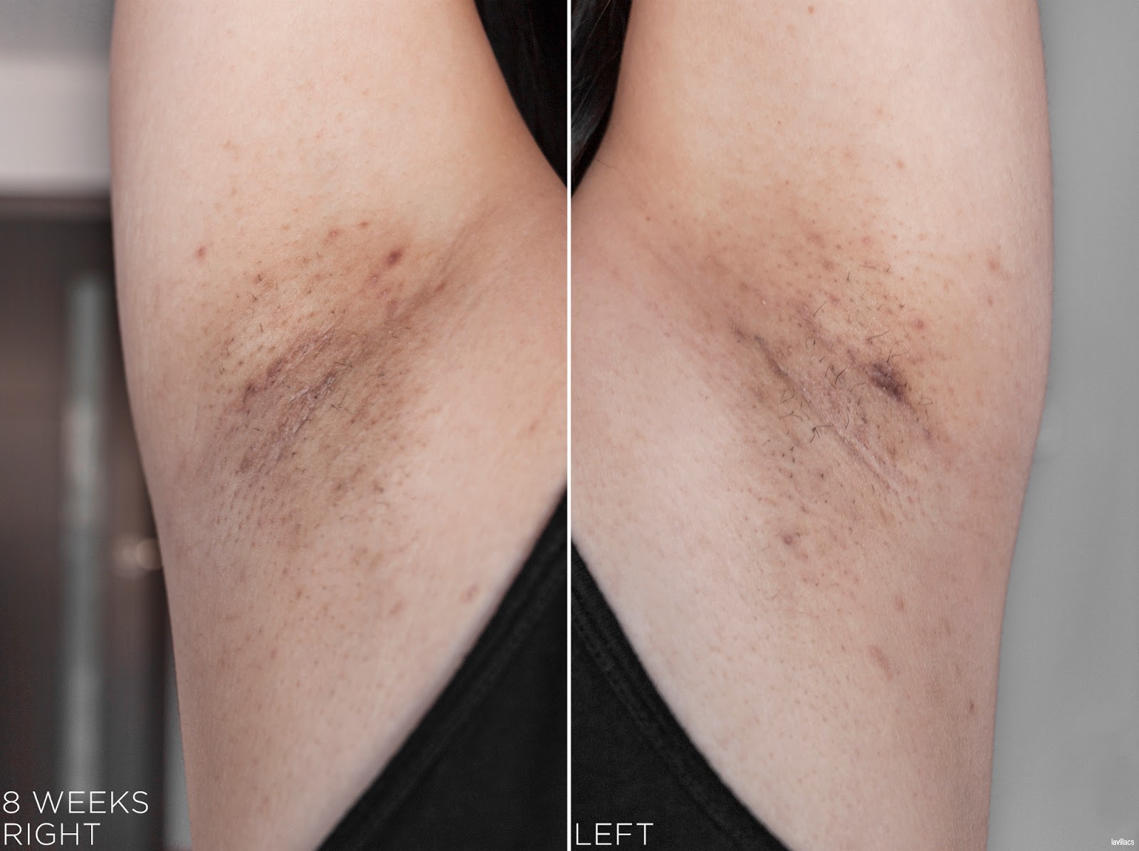 tria Hair Removal Laser Armpits Hair 8 Weeks