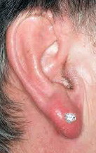 A case of double buried earrings in earlobes uncommon complication   SpringerLink