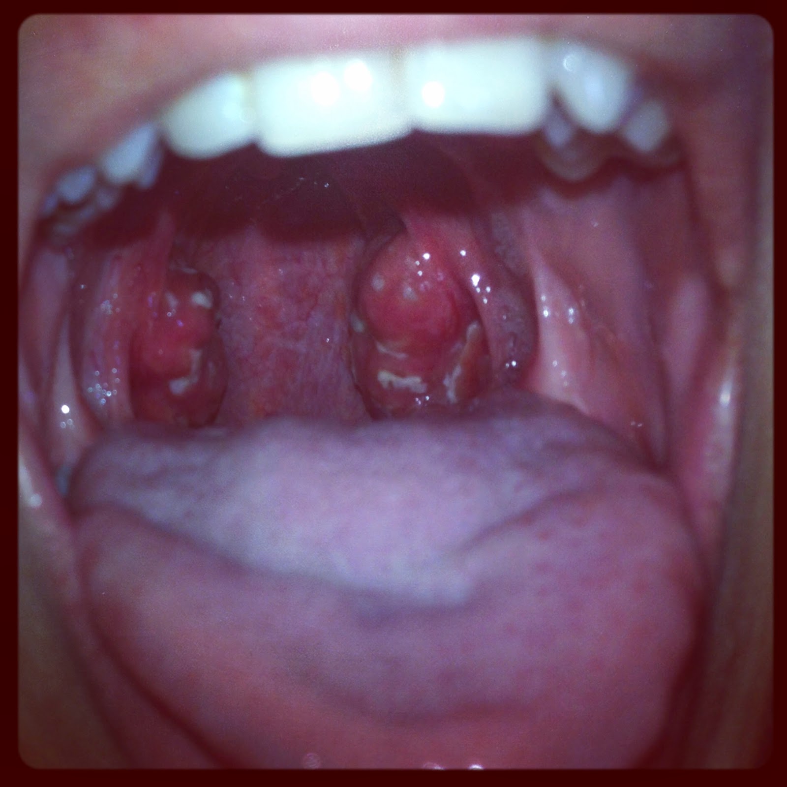 Strep Throat Tonsils 43