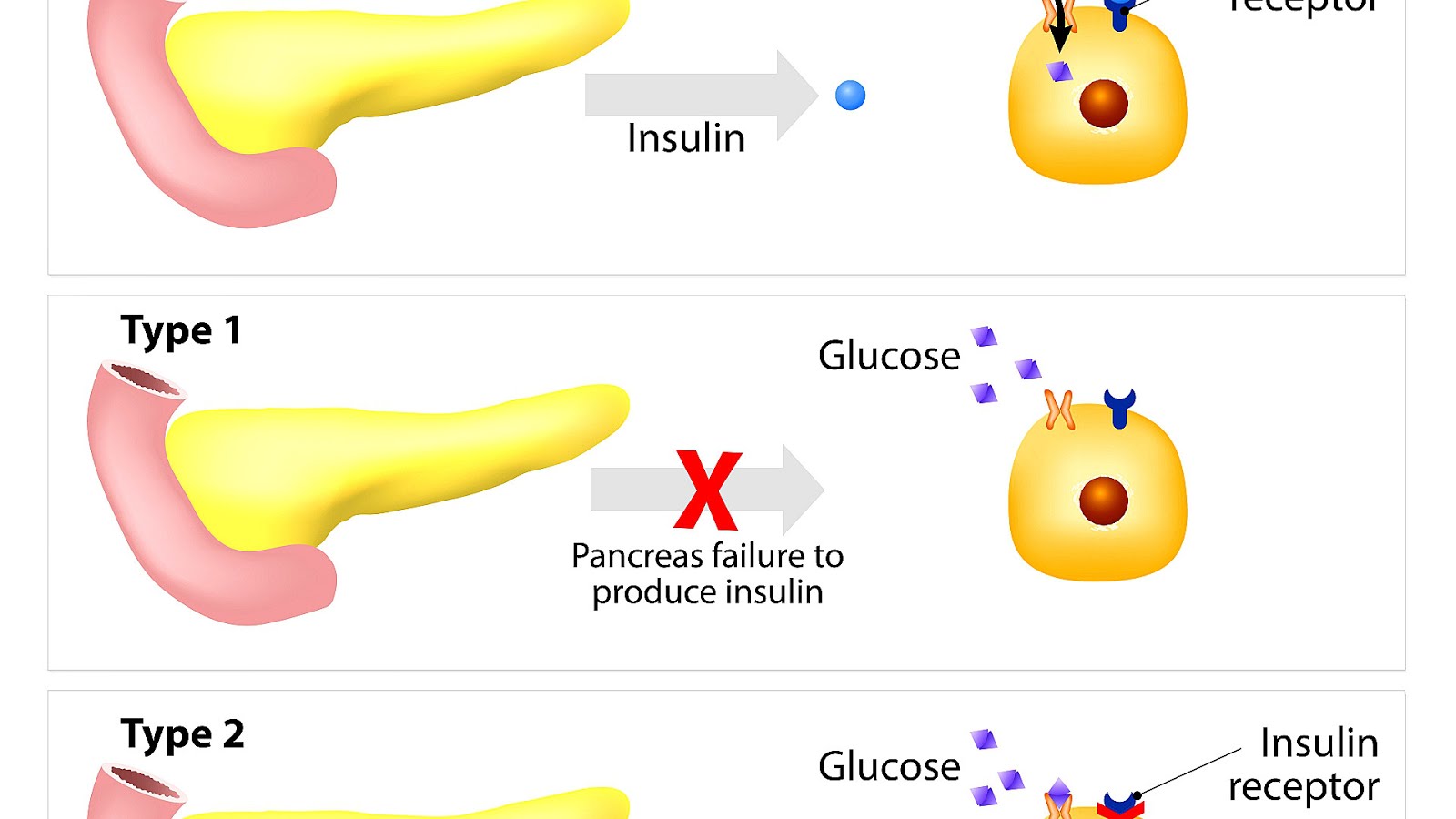 Diabetes mellitus type 1 Insulin Insulin Choices
