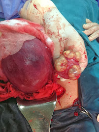 Lt.ovarian cystic teratoma discovered during cesarean section