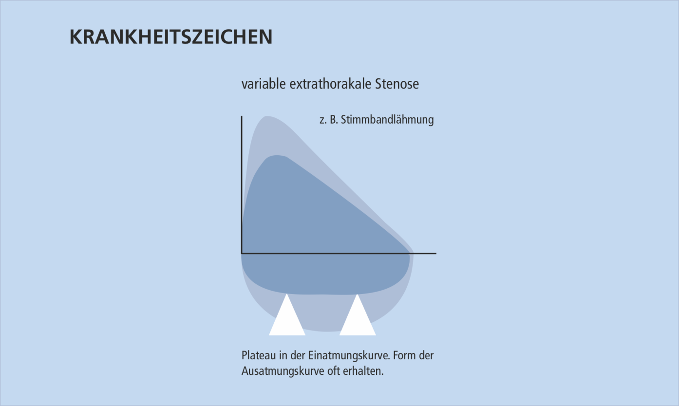 stimmbandlähmung Germany News Collections