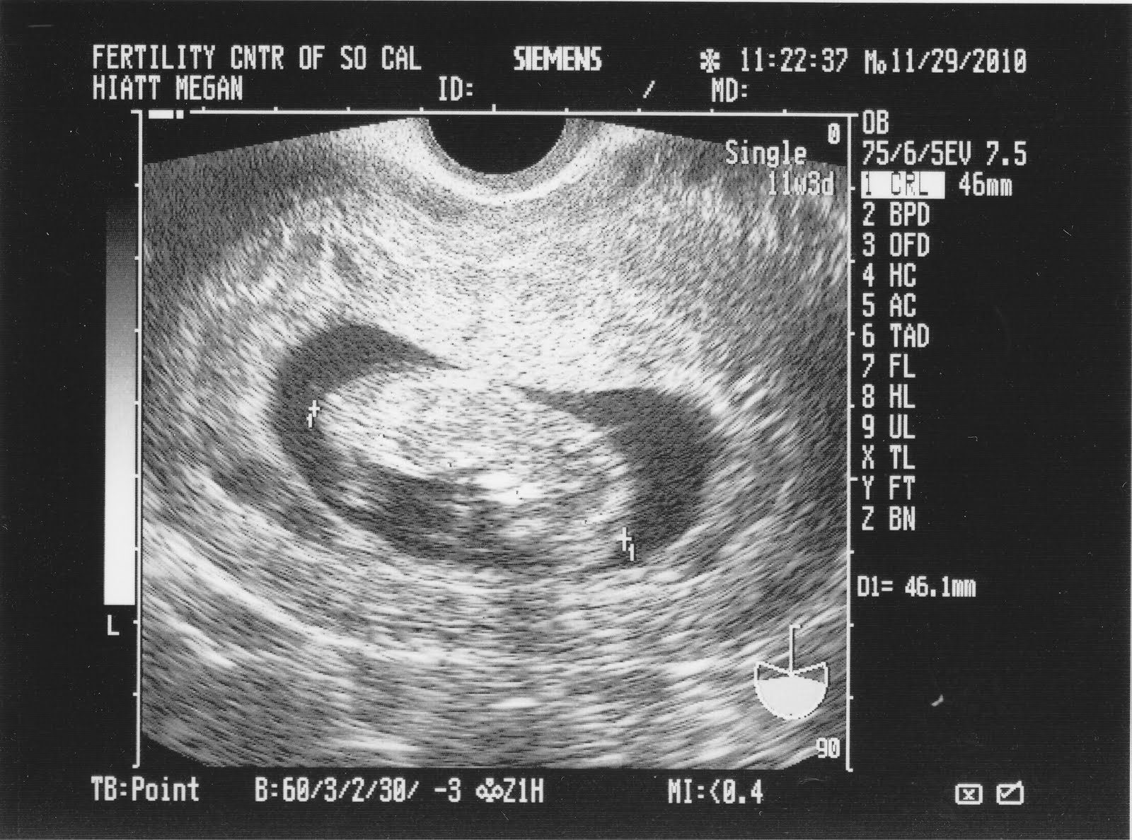 Плод 11 недель фото. 11 Неделя беременности 11 неделя беременности. Размер эмбриона на 11 неделе беременности. УЗИ 11 недель беременности. УЗИ 11 недель беременности размер плода.