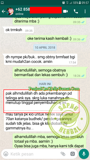 Cara Ampuh Menyembuhkan Telinga Bernanah Menahun Secara Total Cara Ampuh Menyembuhkan Telinga Bernanah Menahun Secara Total