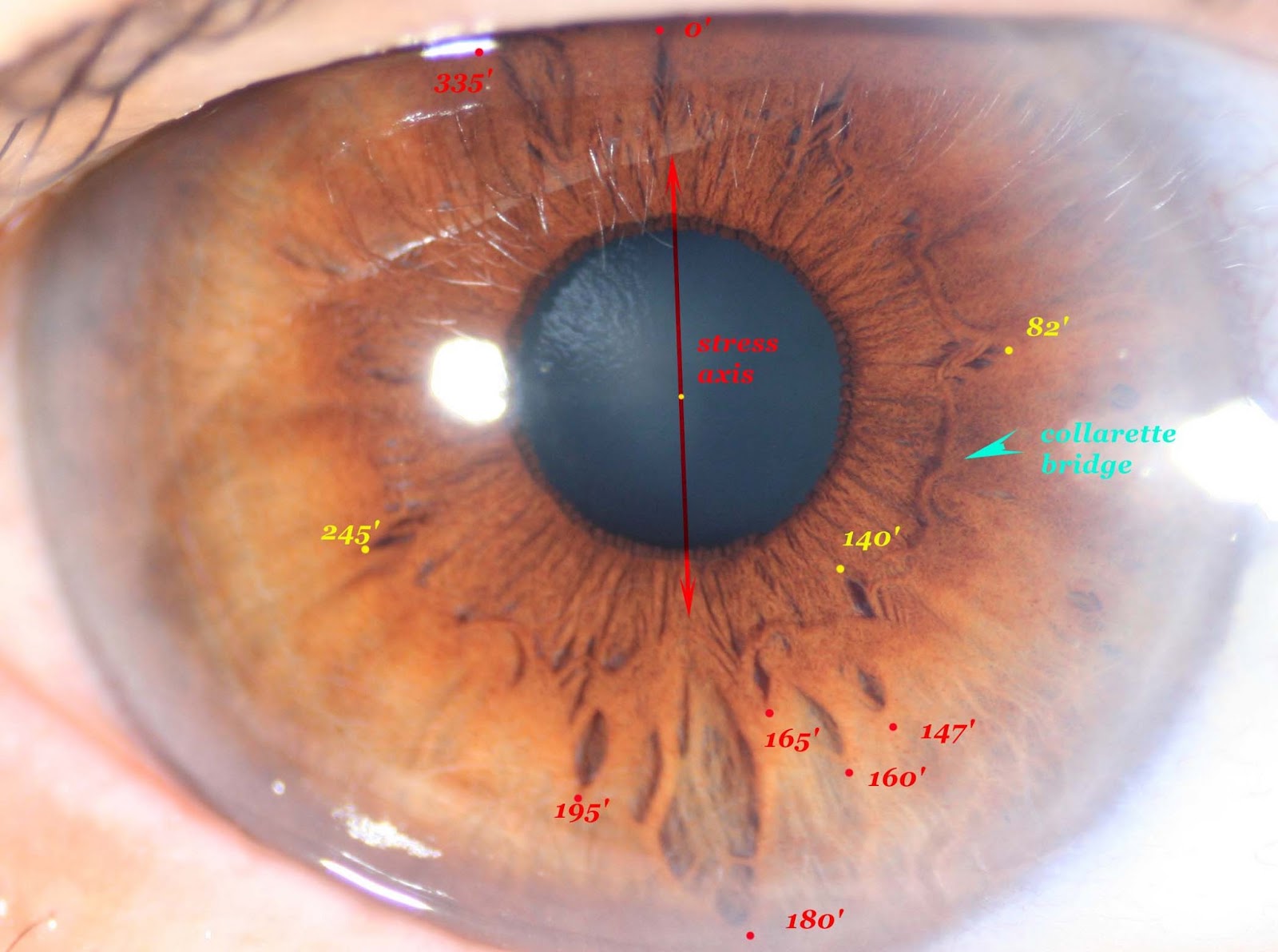 Modern & Multidimensional Iridology: The Stress Axis, Crypts at ...