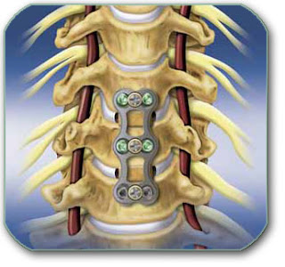 Discus hernia: Vratna kičma