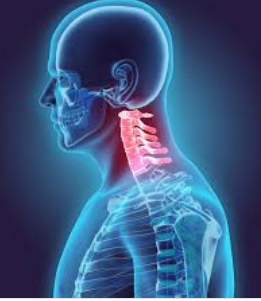SOLACE PHYSIOTHERAPY Cervical Radiculopathy and Physiotherapy treatment
