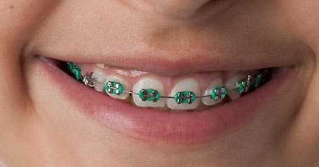 ألوان تقويم الأسنان 2020 كيفية اختيار اللون المناسب بأسهل طريقة