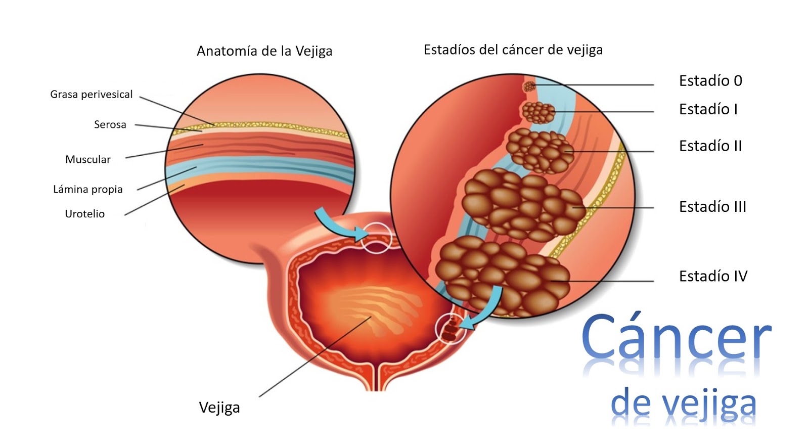 Cuando el cáncer de vejiga está sólo en la superficie Cuando el cáncer de vejiga está sólo en la superficie