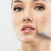 5 Acne Treatment Tips You Can Use Today 5 Acne Treatment Tips You Can Use Today