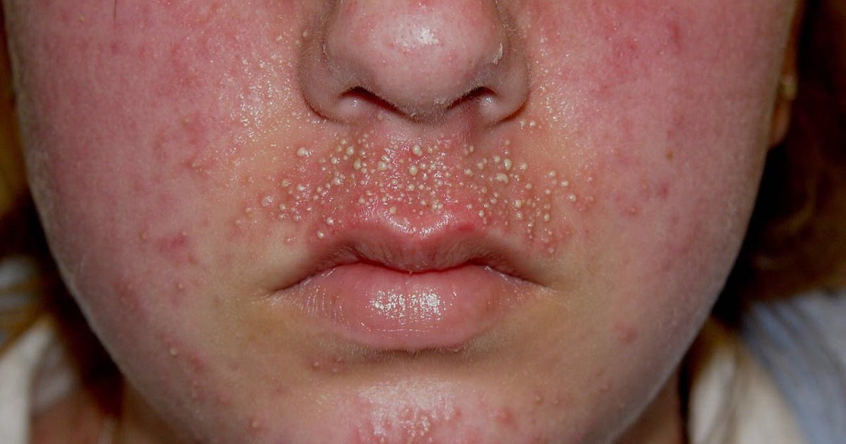 ACNE BAKING SODA AND TOOTHPASTE SPOT CREAM BOUQUI