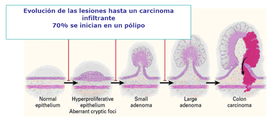 evolución natural de cáncer de colon a partir de pólipos en la mucosa