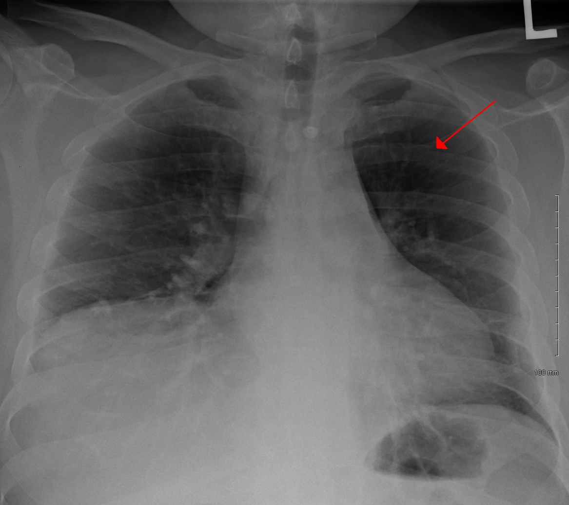 локальный перелом ребра
