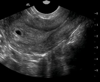 Endovaginal Ultrasound Pictures 20